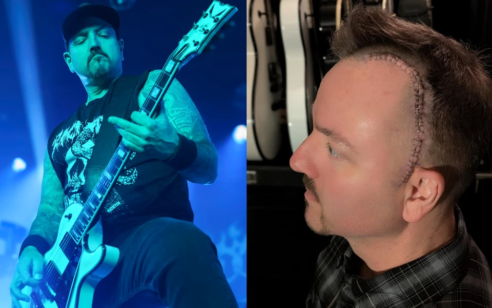 Китаристът на Hatebreed претърпя сериозна мозъчна операция